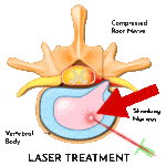 Laser Spine Surgery Center In Atlanta Ga Allspine