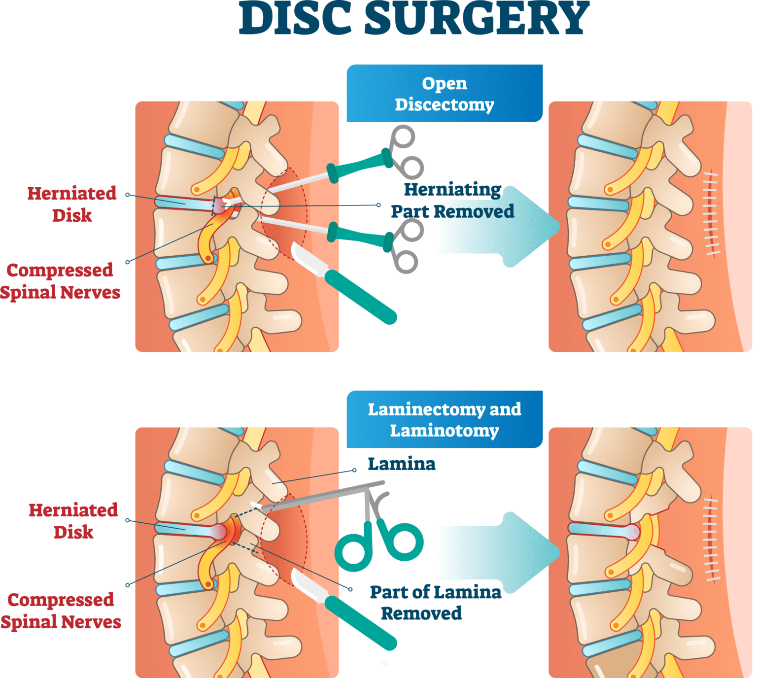 sciatica-surgery-types-laser-spine-center