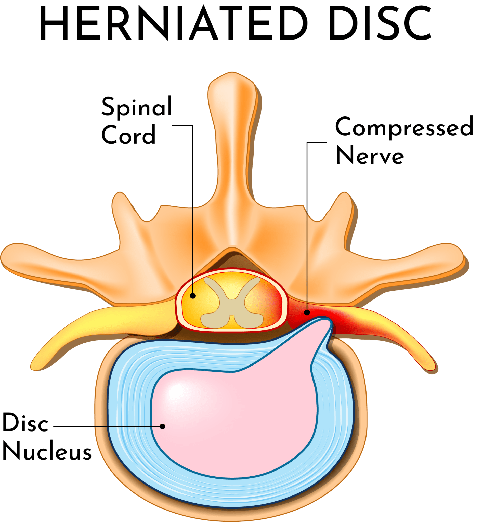 Crick in the Neck Pain & Stiffness | Laser Spine Center