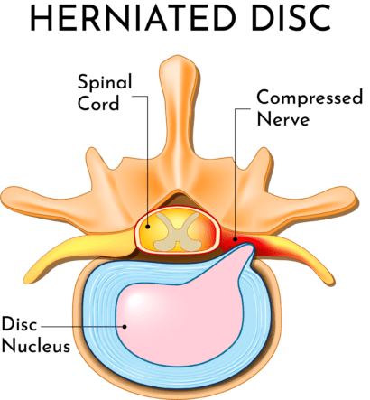 herniated-disc-neck-pain | Laser Spine Center